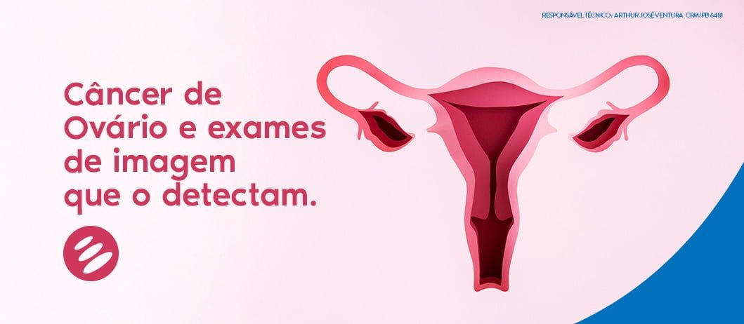 Você sabe os exames que detectam o câncer de ovário?